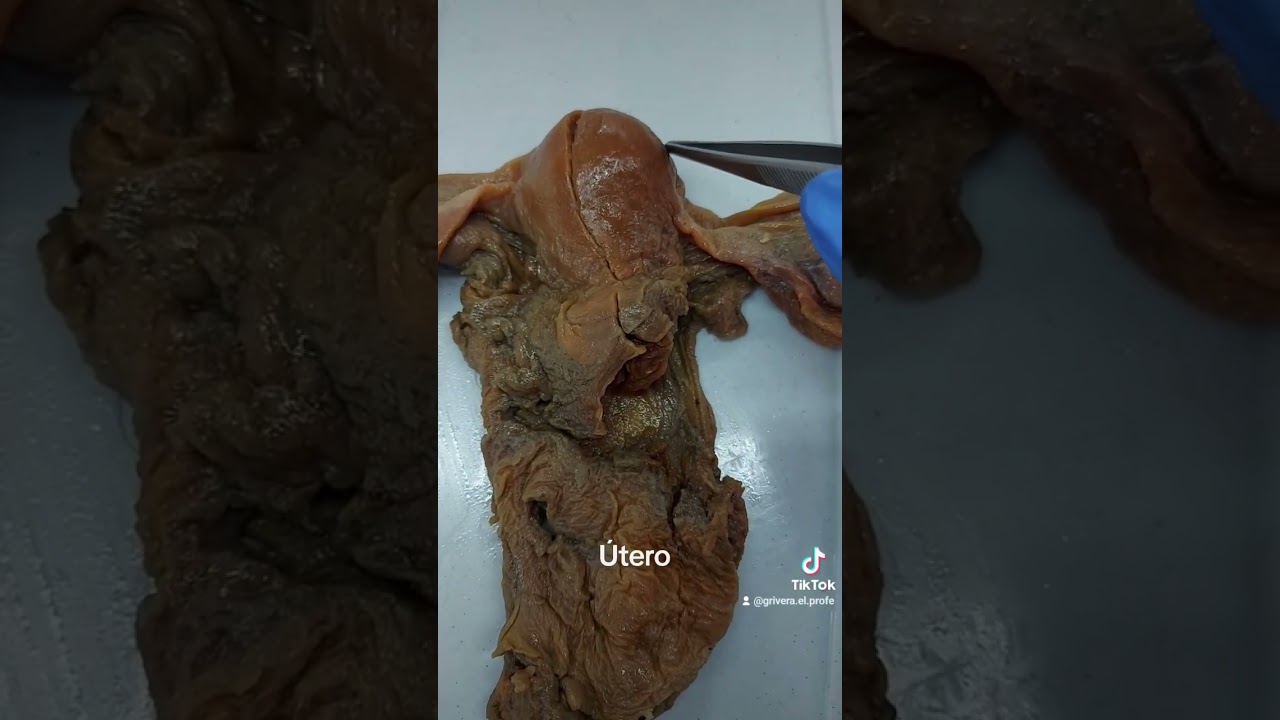 El &uacute;tero humano y sus cuatro partes: fondo, cuerpo, istmo y cuello o c&eacute;rvix