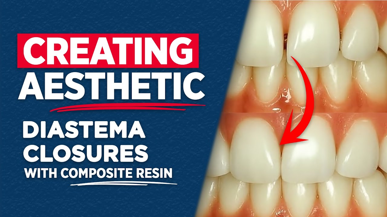 Creating Aesthetic Diastema Closure With Composite Resin