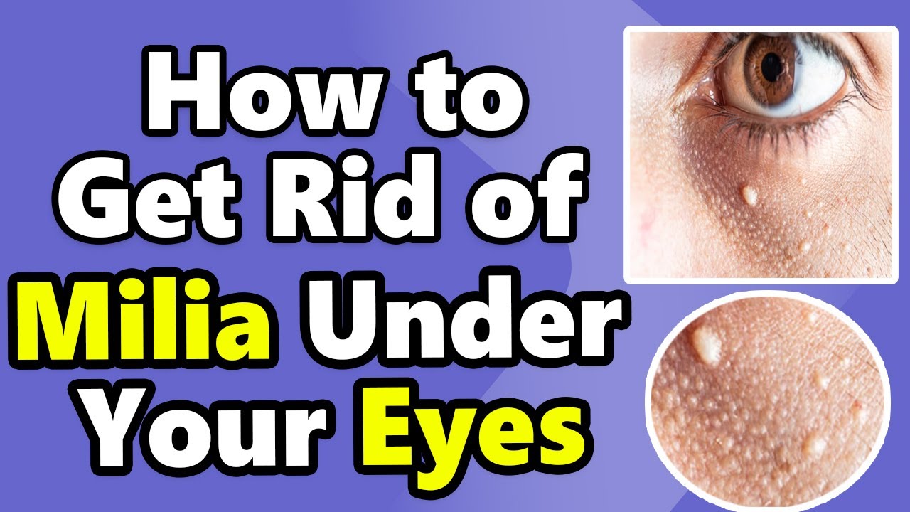 How to Get Rid of Milia Under Your Eyes