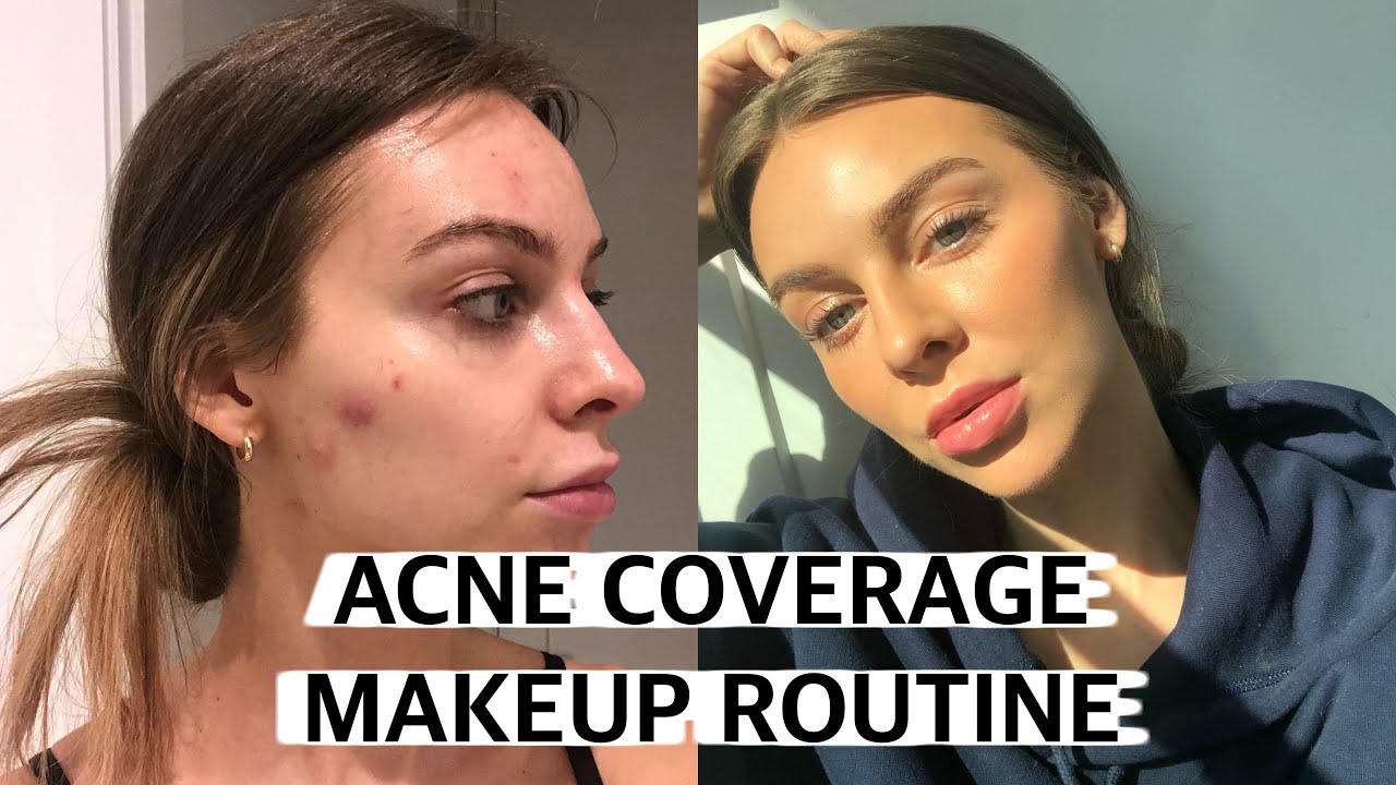 Full Acne Coverage Foundation Routine + Natural Makeup ♡
