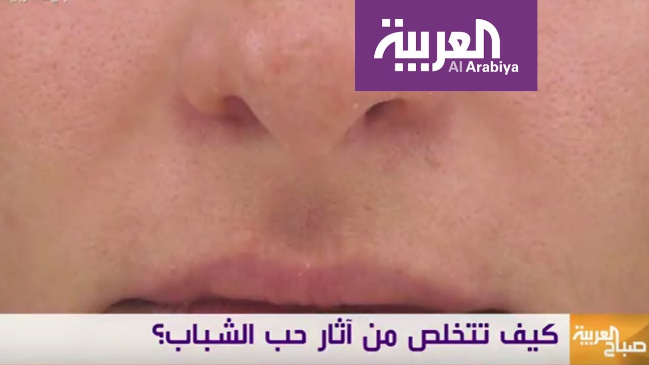 صباح العربية: طرق فعالة ومختلفة لعلاج ندبات حب الشباب