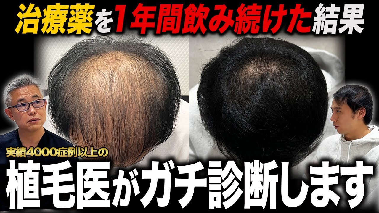【衝撃の結末】AGA治療薬を1年間飲み続けた結果、植毛はできるのか？