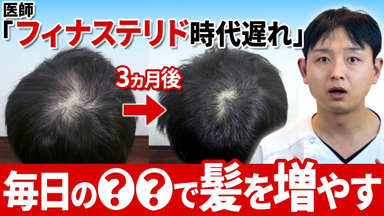 【衝撃】1年間ミノキで生えなかった人が、たった3ヶ月で変わった発毛方法(フィナステリド時代遅れ)
