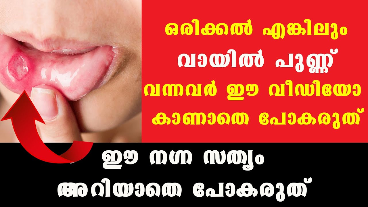 ഒരിക്കലെങ്കിലും ഈ പ്രശ്നം അനുഭവിച്ചവര്‍ ഈ വീഡിയോ കാണാതെ പോയാല്‍ നഷ്ടം ആകും ഉറപ്പ് /Dr Manoj Johnson