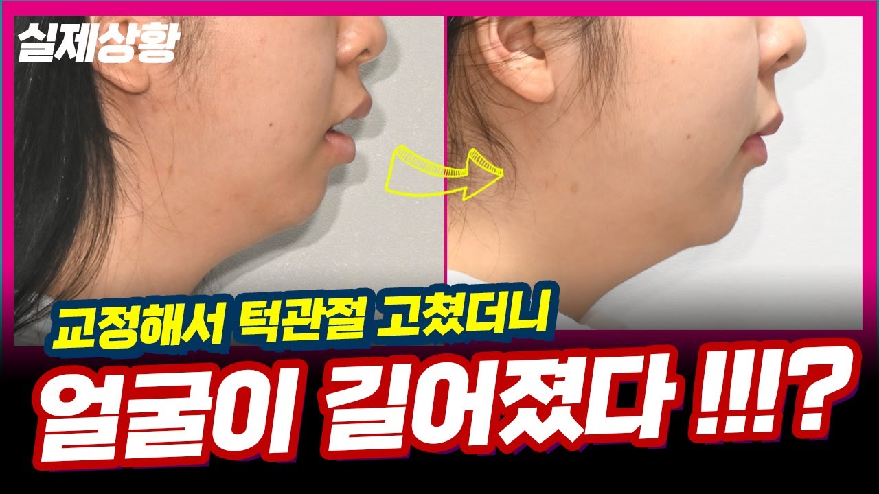 실제사례 : 치아교정 했더니 턱관절이 좋아졌어요. #세상에이런일이 #턱관절통증 #턱관절장애 #치아교정전후 #치아교정과정 #얼굴길이