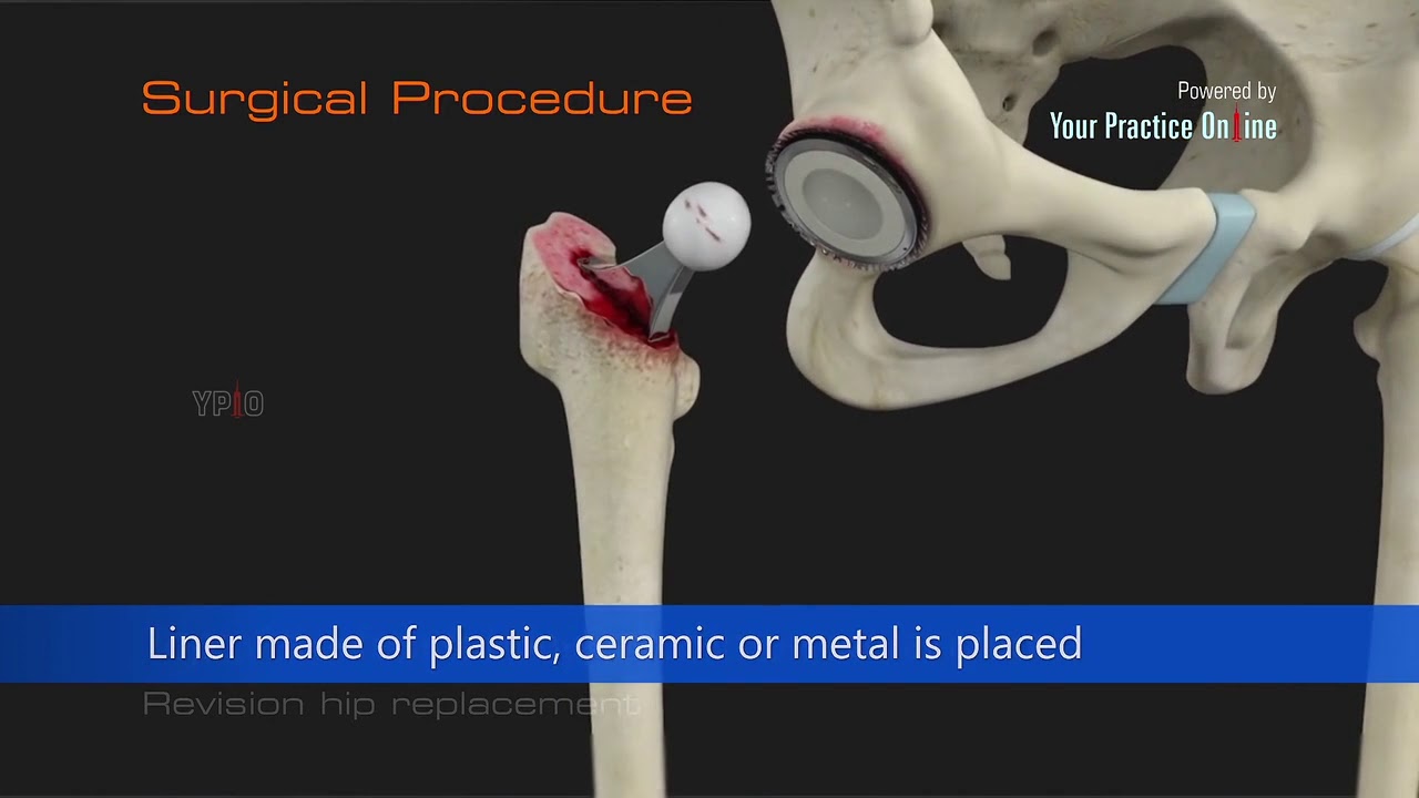 Revision Hip Replacement