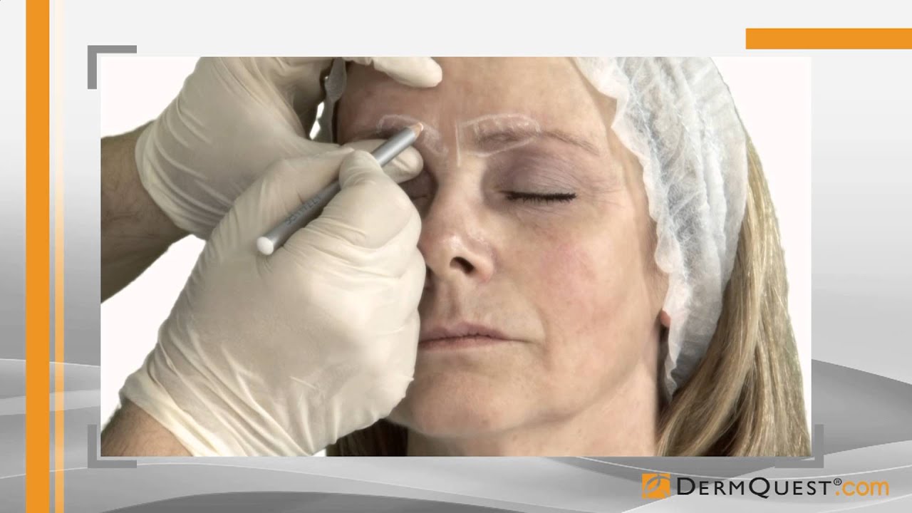 Docteur Kestemont - Injections of Botulinum Toxin in Glabella Area
