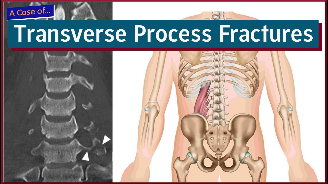 Transverse Process Fractures