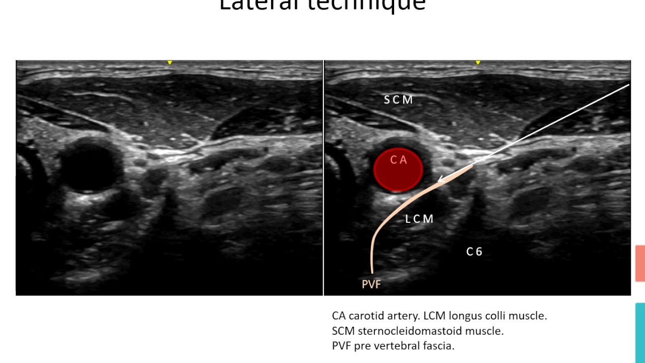 Stellate Ganglion Block