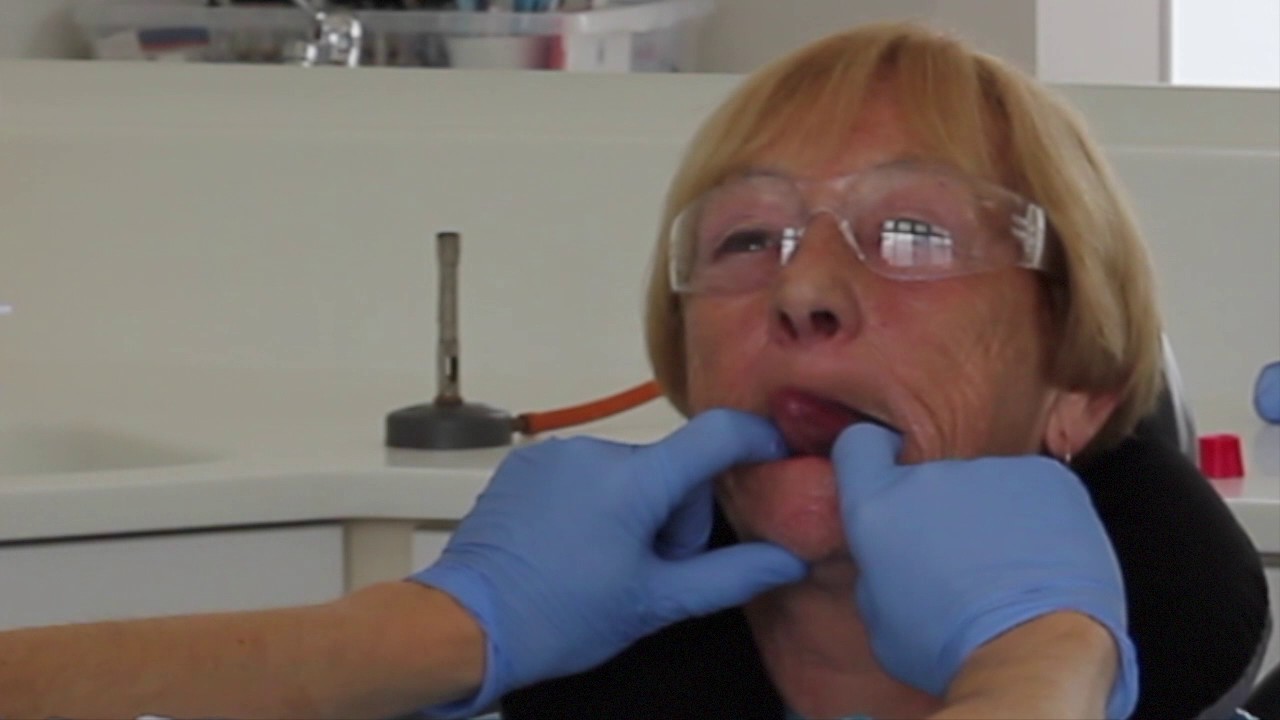 Definitive mandibular impression for complete denture