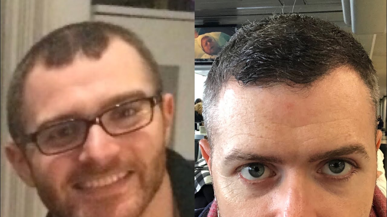 HAIR TRANSPLANT JOURNEY- Week 16 - 4 months! - HLC Ankara