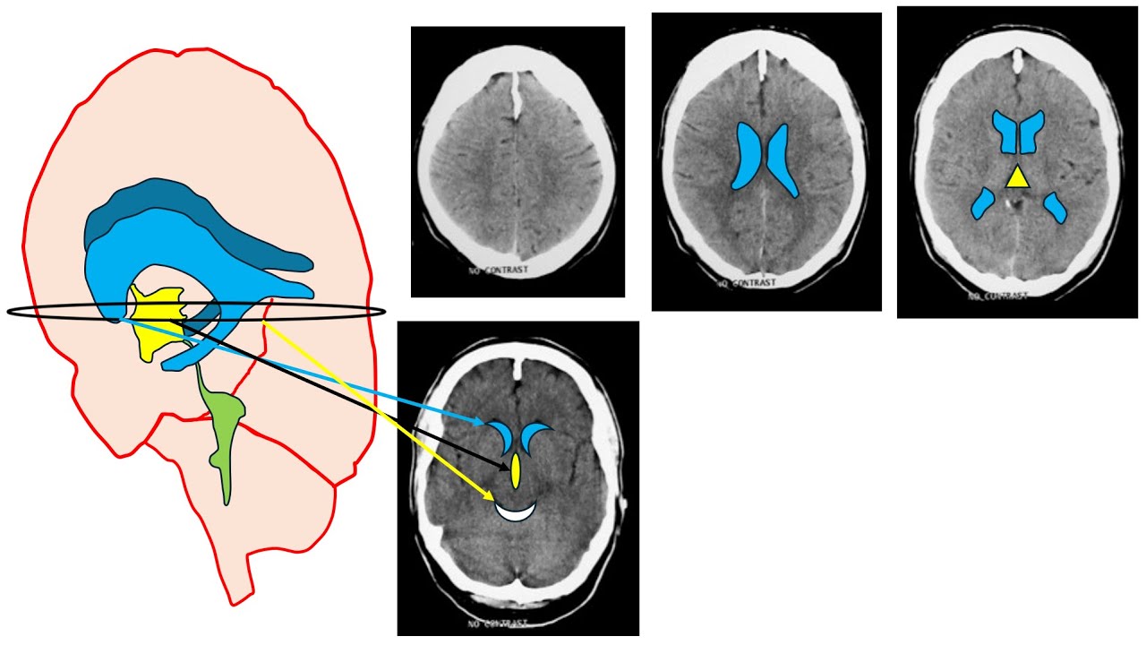 A Simplified approach to disturbed consciousness level