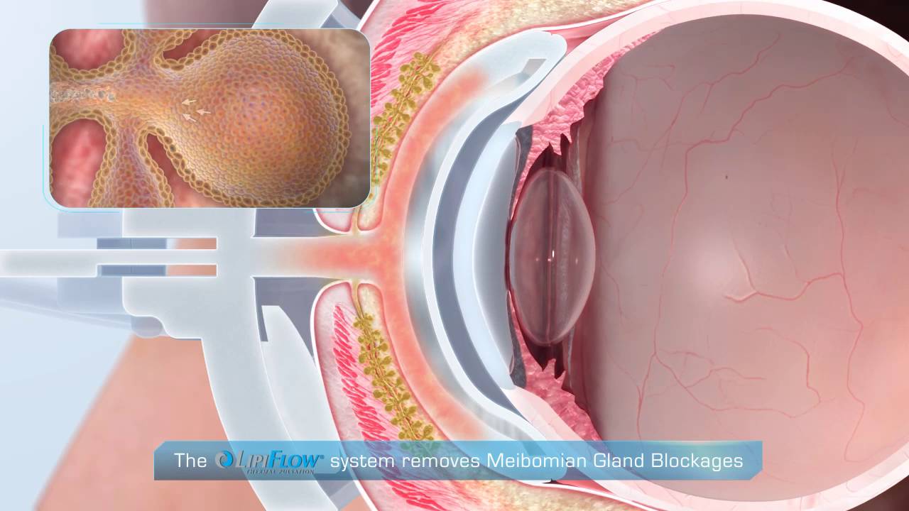 LipiFlow treatment with device