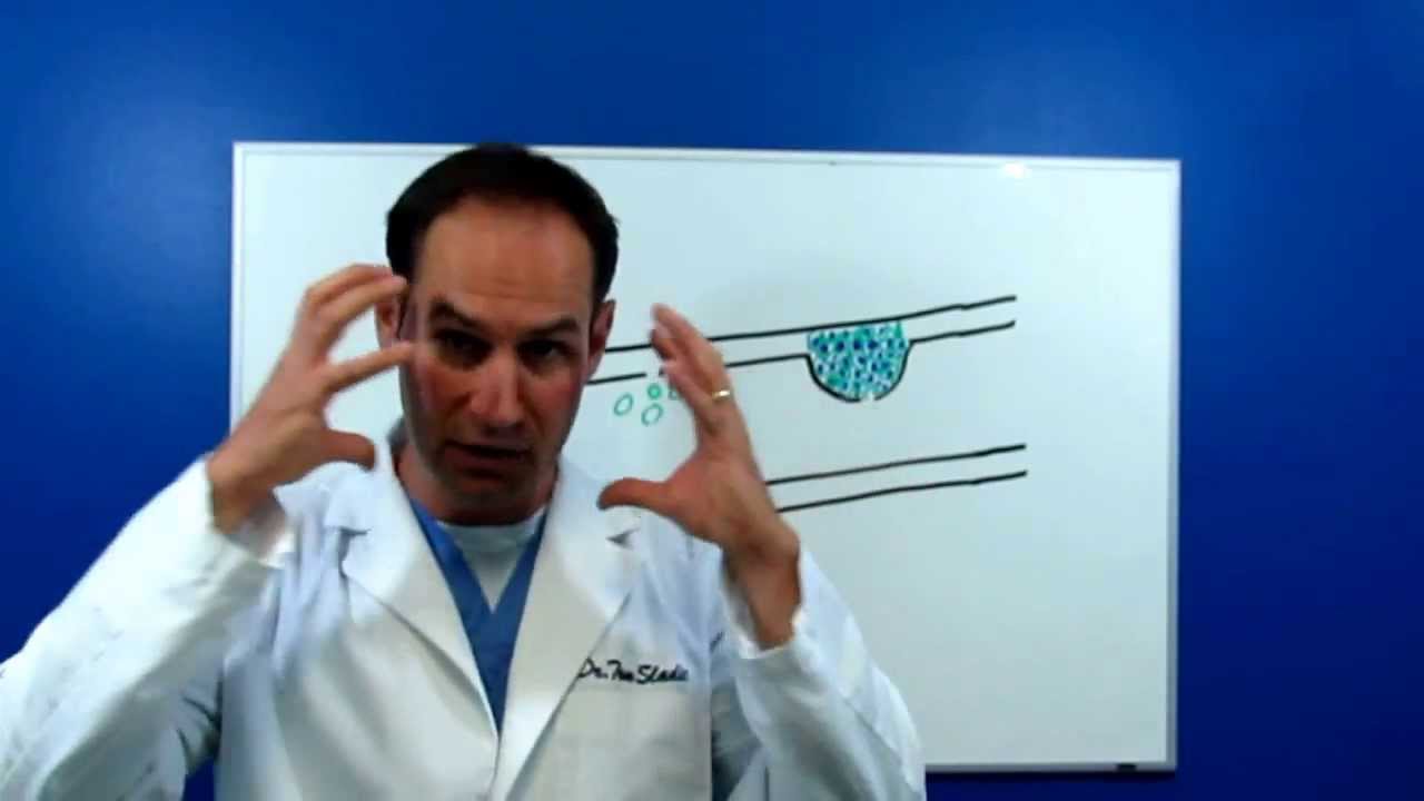 Inflammation the cause of Heart Disease
