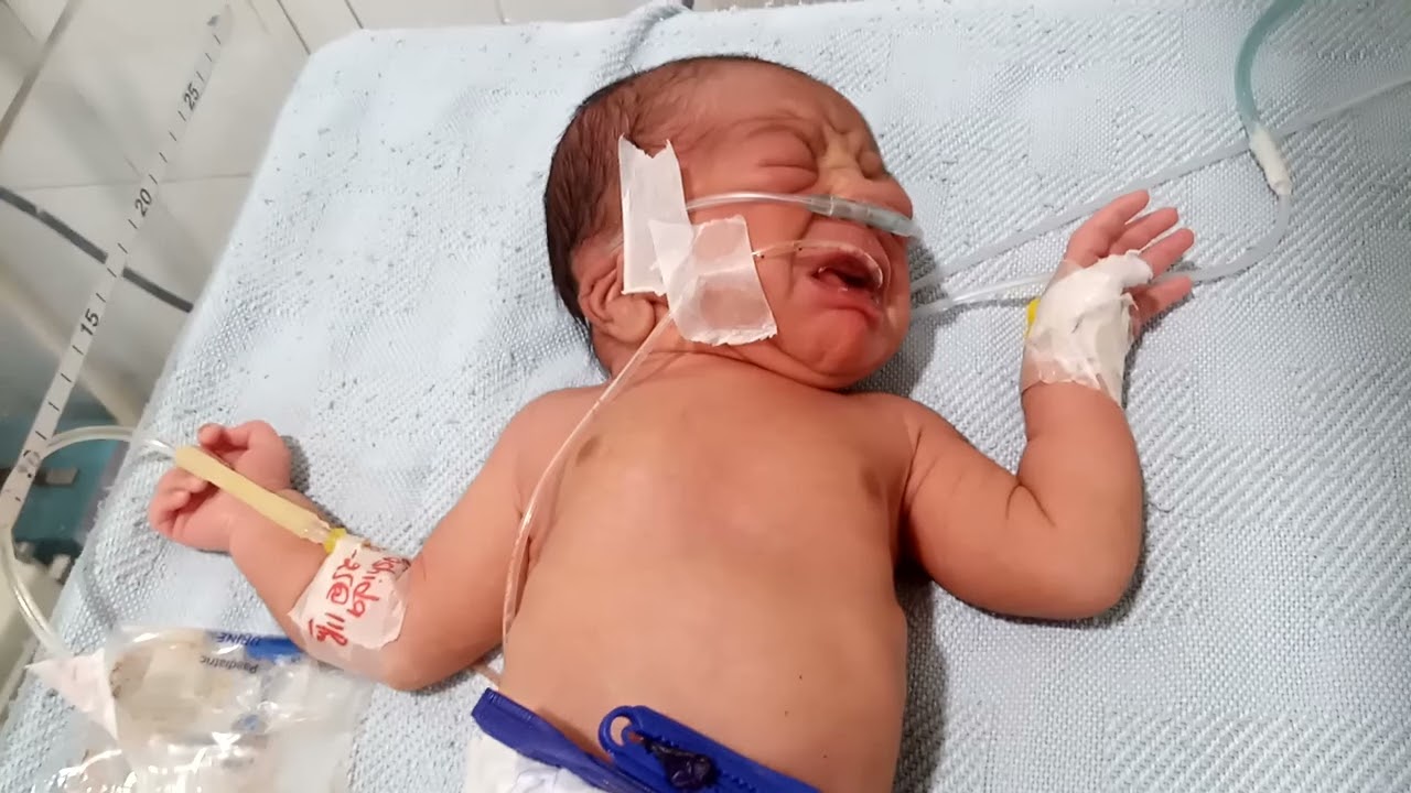 Cute baby come to nicu oxygen dependent poor sucking poor reflex poor NNR oral secretion 
