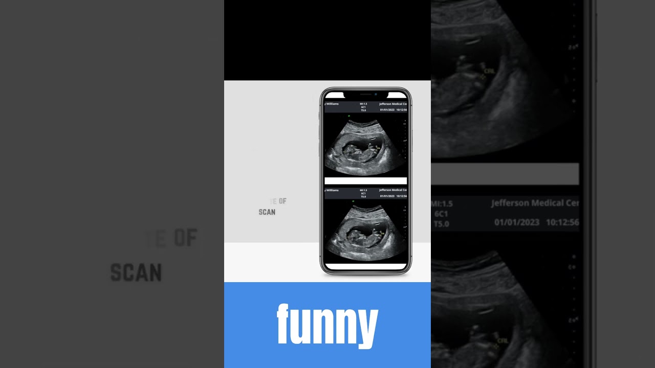#shorts Ultrasound scan 5,6,7,8,9,10,12,20 Weeks Pregnancy | Its a boy | Trimester |girl 3D sonogram