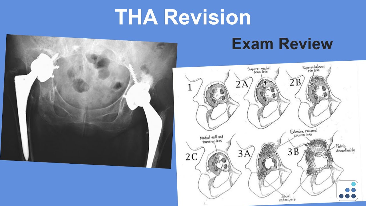 THA Revision Exam Review - Wayne Paprosky, MD