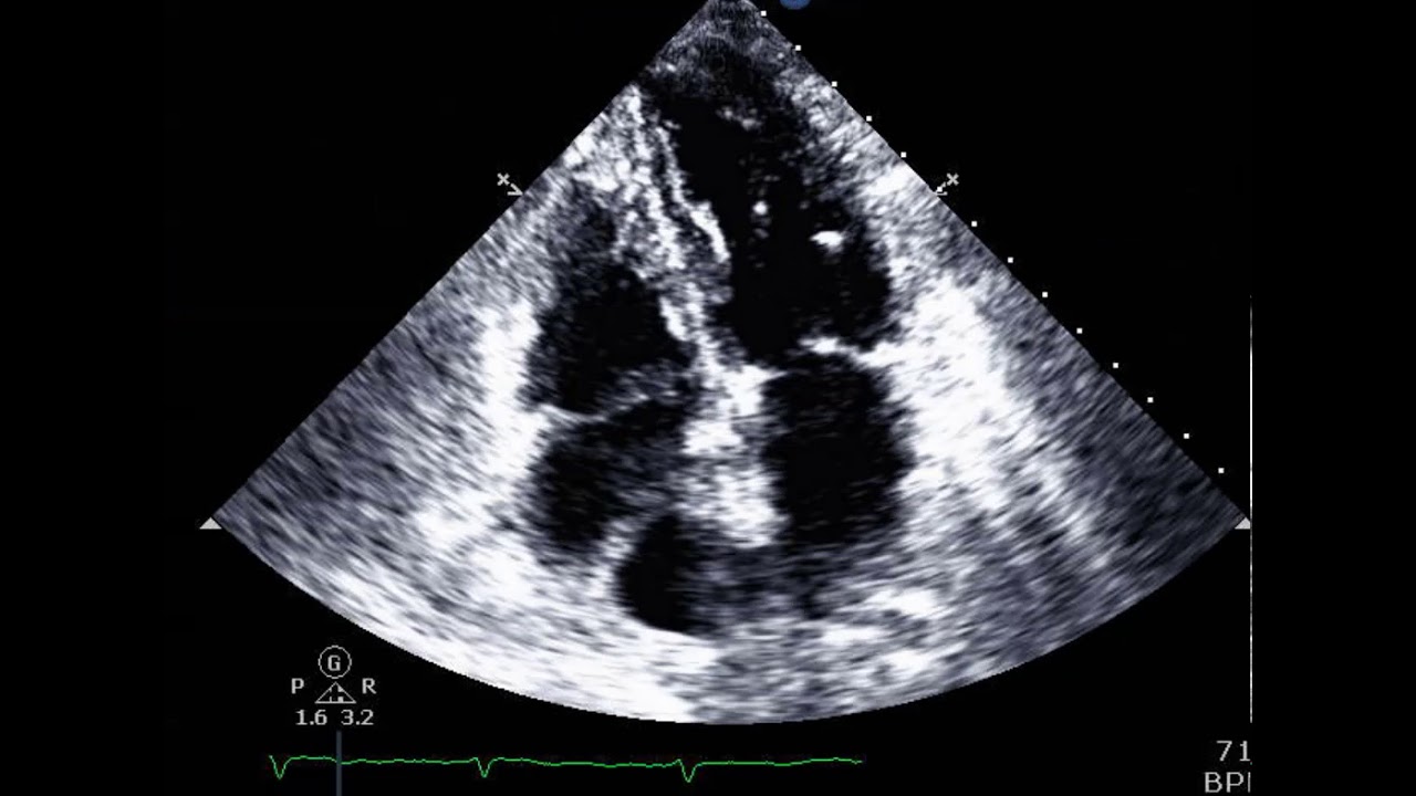 Flail posterior mitral valve leaflet