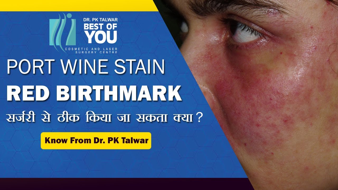 Can Port Wine Stain (Red Birthmarks) be Removed by Surgery | Dr. PK Talwar