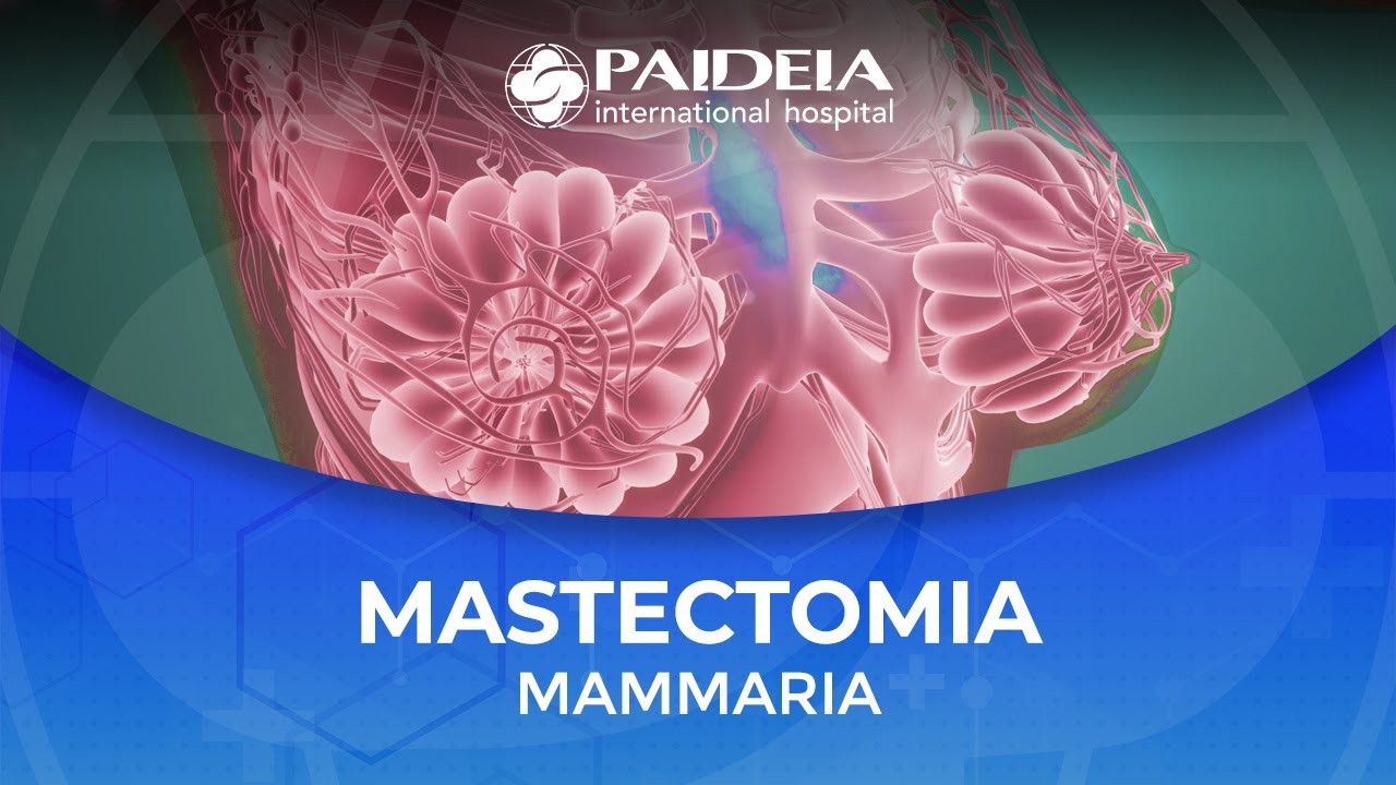 La mastectomia mammaria