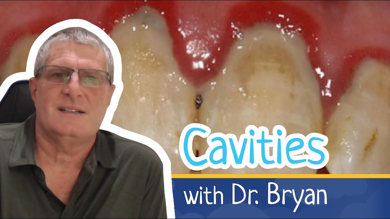 Sugar and Cavities - What is the relationship between the two?