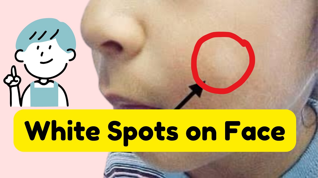 White Spots on Child's Face? It's Probably Not Vitiligo
