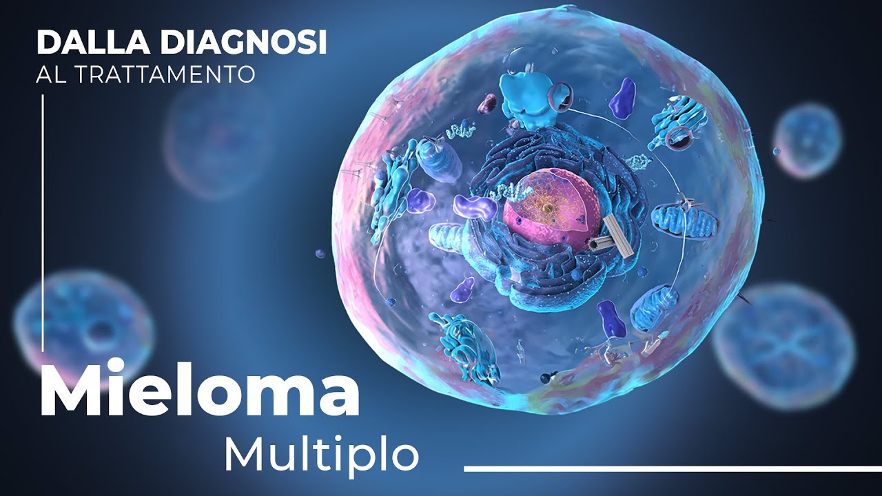 Svelare il Mieloma Multiplo: Dalle Cause al Trattamento