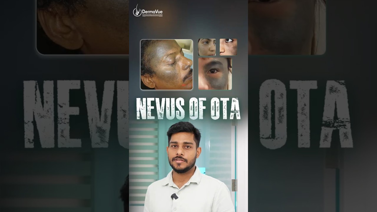 ✨Nevus of OTA