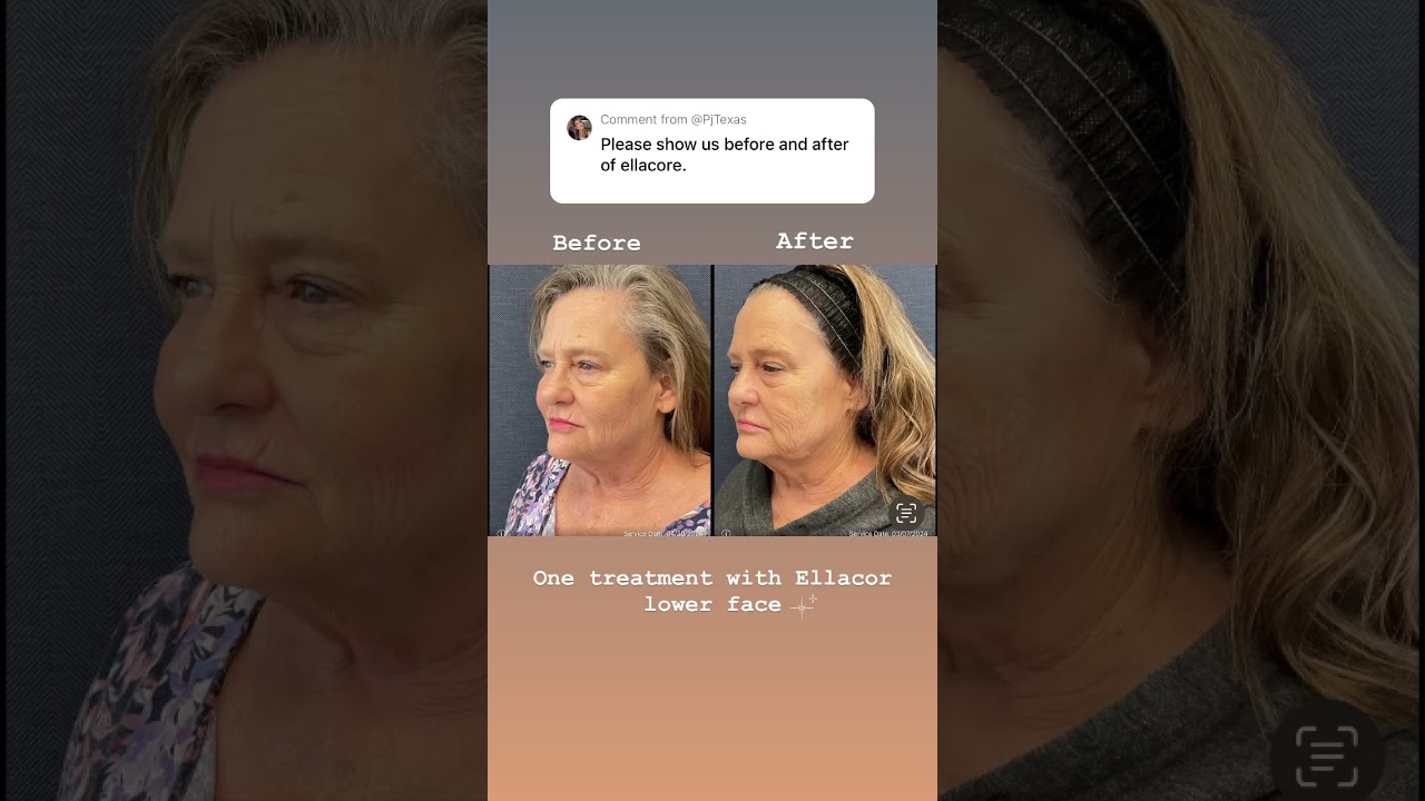 Ellacor non-surgical tightening and lip lift 