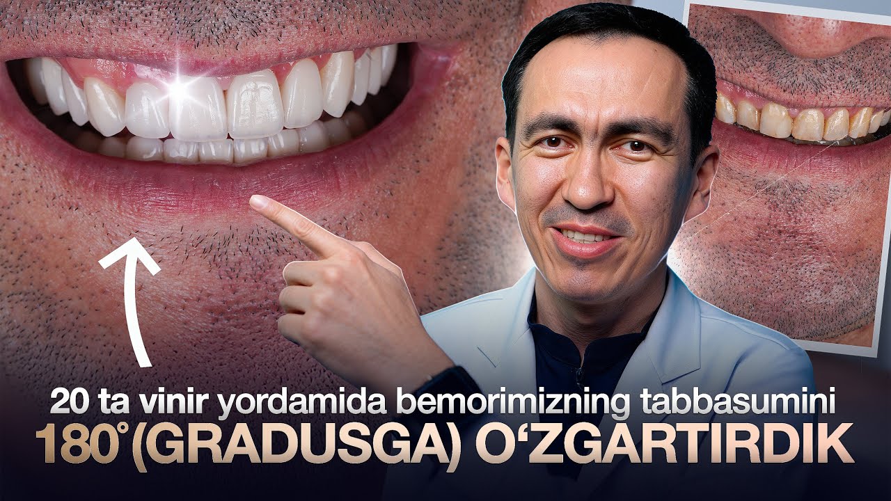 😨Hech qanday briketsiz, 20 ta vinir yordamida tishlarini ideal holatga keltirib berdik! #vinir