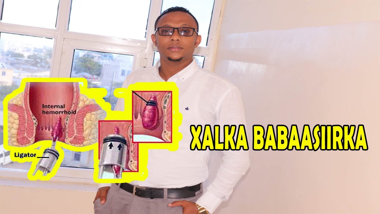 sida ugu fudud ee aad iskaga daweyn karto babaasiirka (Dr-qadar)