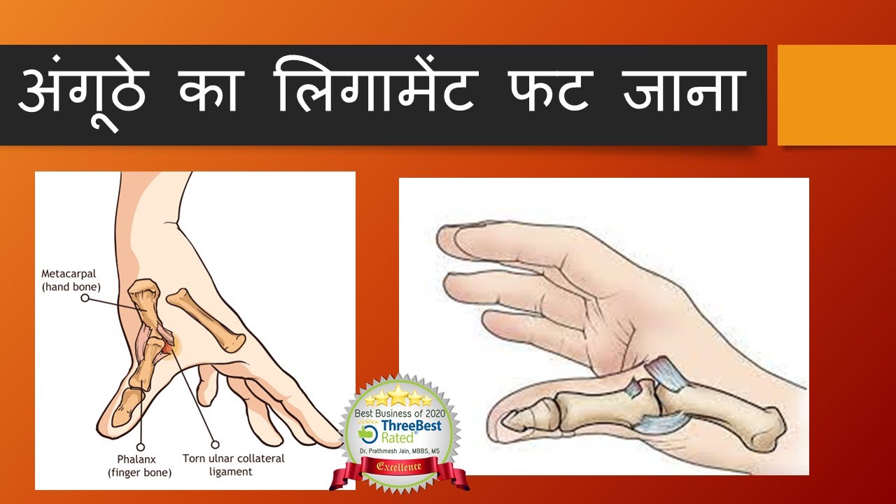 All about ligament injury of thumb in Hindi.