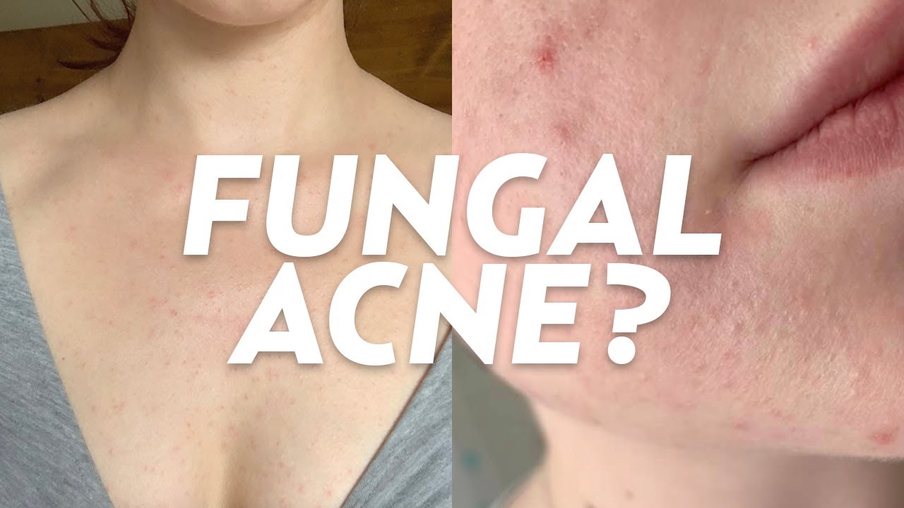 What is Fungal Acne? We Discuss Skincare Treatments, Causes, & More!