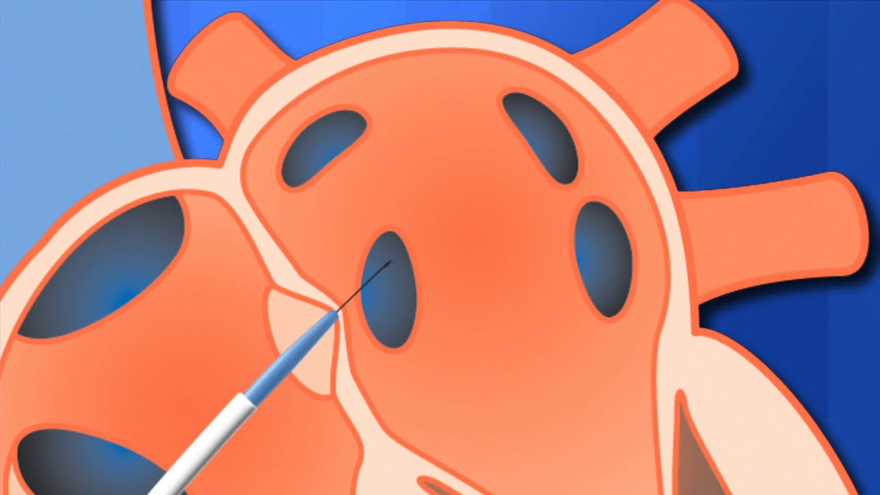 SafeSept Transseptal Guidewire Instructional Video Life Systems Medical Australia