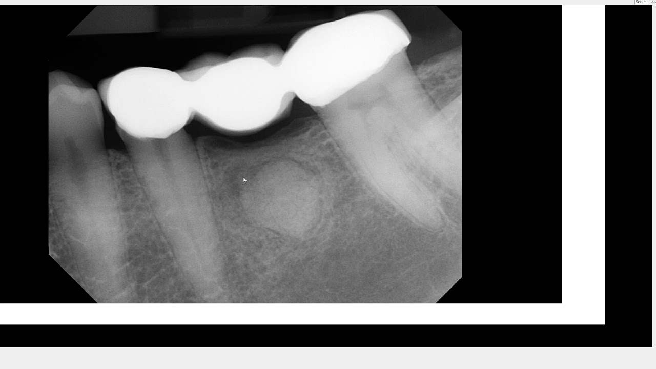 10-year radiographic follow-up on periapical osseous dysplasia (cemento-osseous dysplasia)