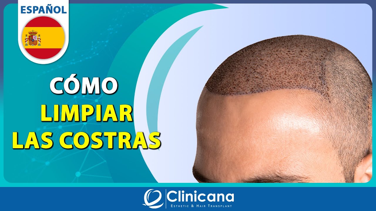 Cómo limpiar las costras después de 11 días de la operación de trasplante de cabello