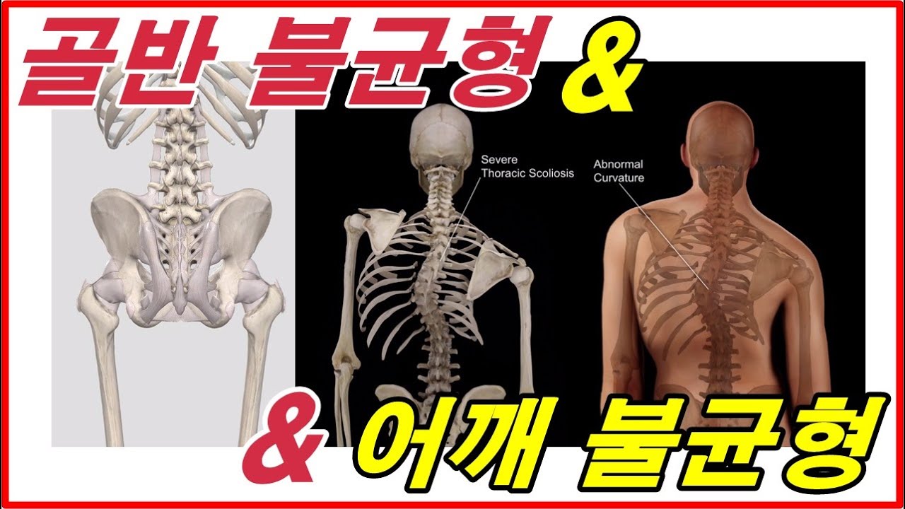 골반불균형 & 어깨불균형 하지정렬을 확인 해보세요!! 골반교정, 전방경사,후방경사,측방경사!! 내전근운동, 치골근운동, 엉덩이운동, 햄스트링운동으로 기능회복을 합니다.