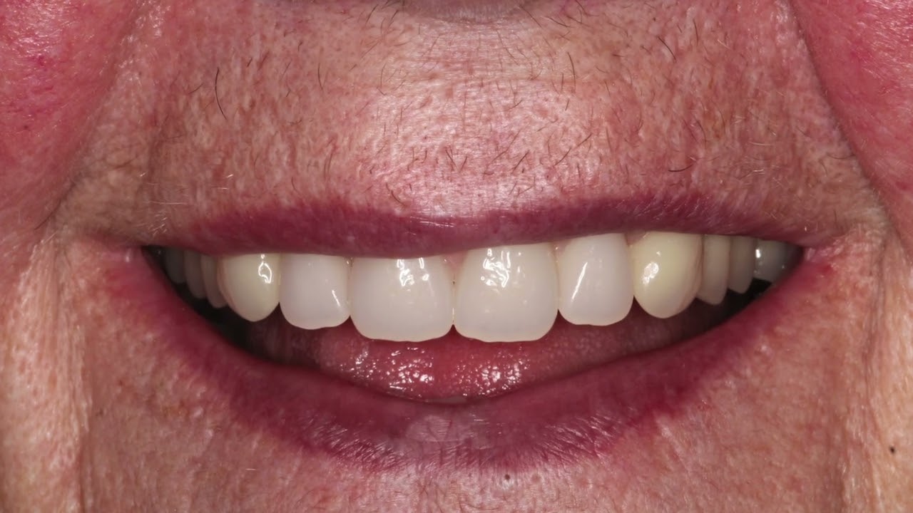 Premium acrylic denture 1