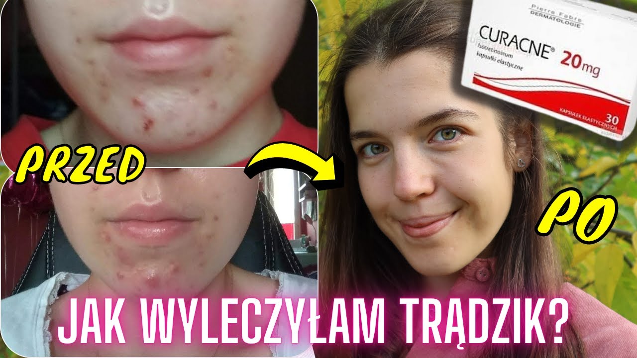 JAK WYLECZYŁAM TRĄDZIK? - MOJA HISTORIA I CURACNE