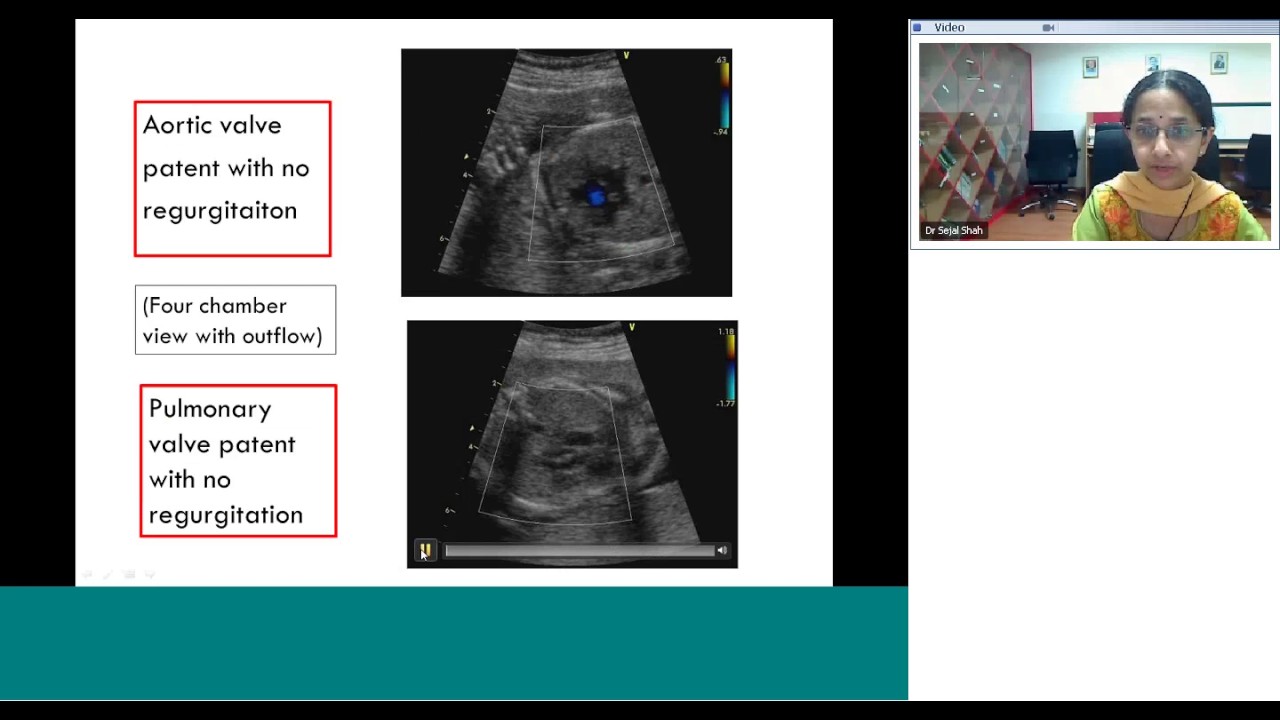 Fetal echo part 3 by Dr Sejal Shah