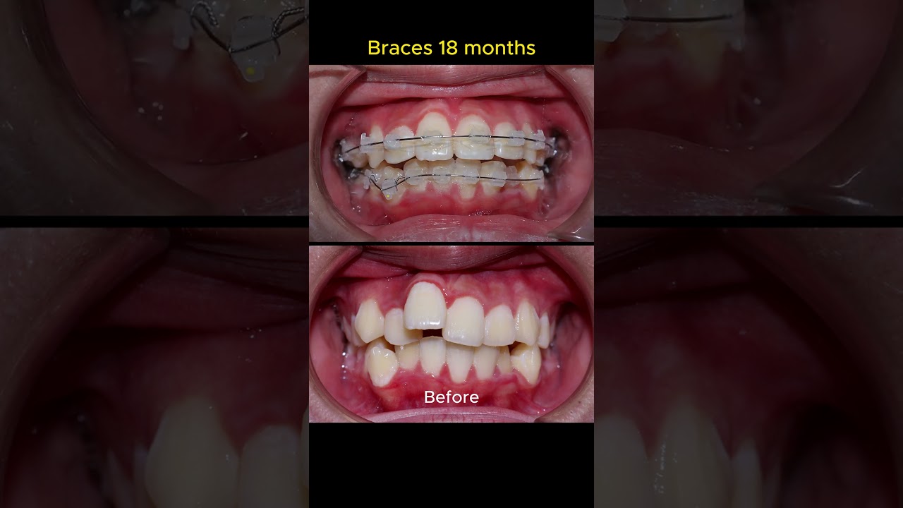 Braces process in 18 months