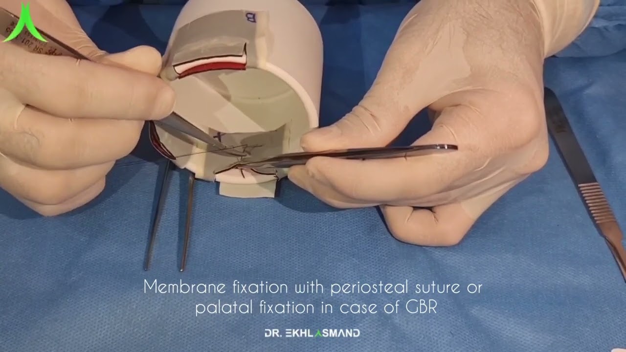 membrane fixation with periosteal suture or palatal fixation in case of GBR