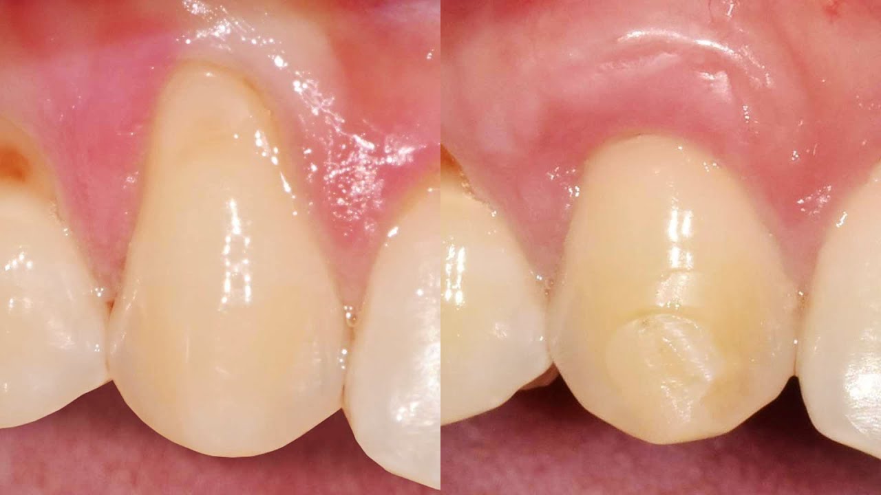 잇몸내려앉음, 잇몸재생 유도제 '엠도게인'을 활용한 잇몸이식 치료 사례