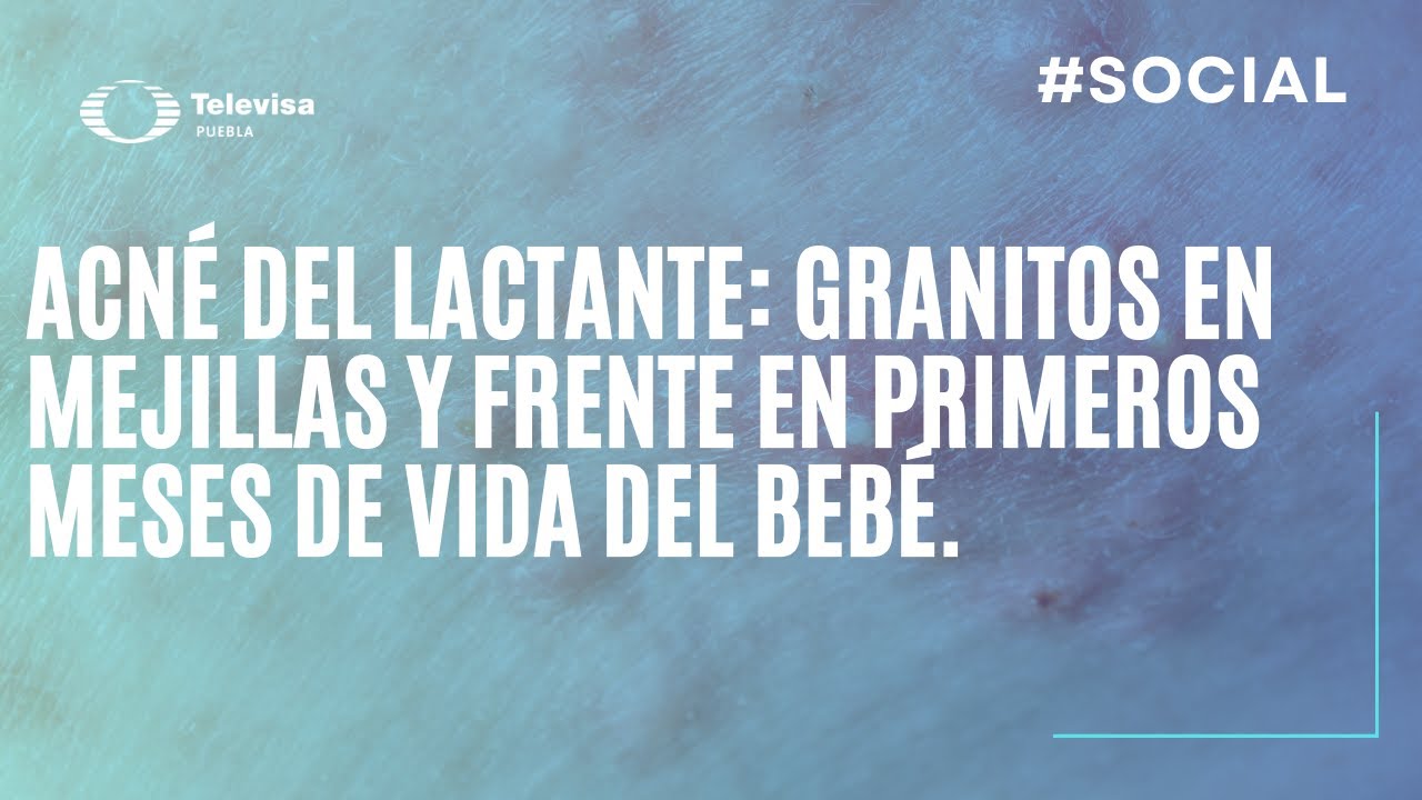 Acné del lactante: ¿Qué es y cómo tratarlo?