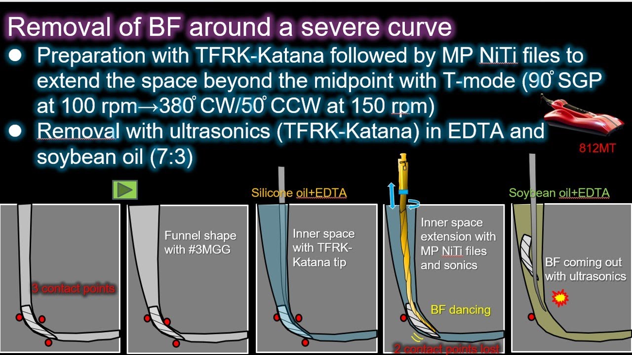 New technique to removal BFs around a severe curve/強度湾曲根からの新たな破折器具除去法