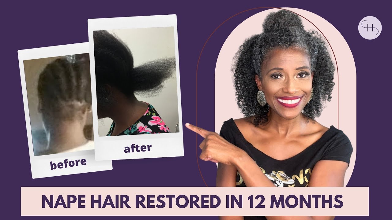 From Hair Loss to Hair Gain: Incredible Transformation