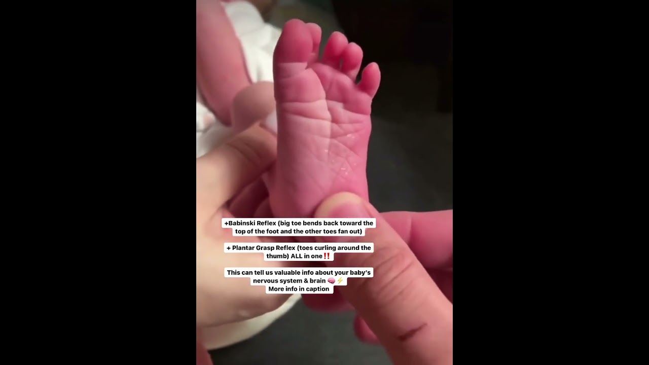 BABINSKI Reflex + PLANTAR GRASP Reflex at the same time!