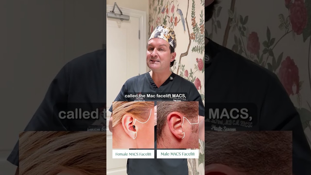 In today’s video, Dr. Marc Dupéré explains how facelift scars are carefully planned, including varia