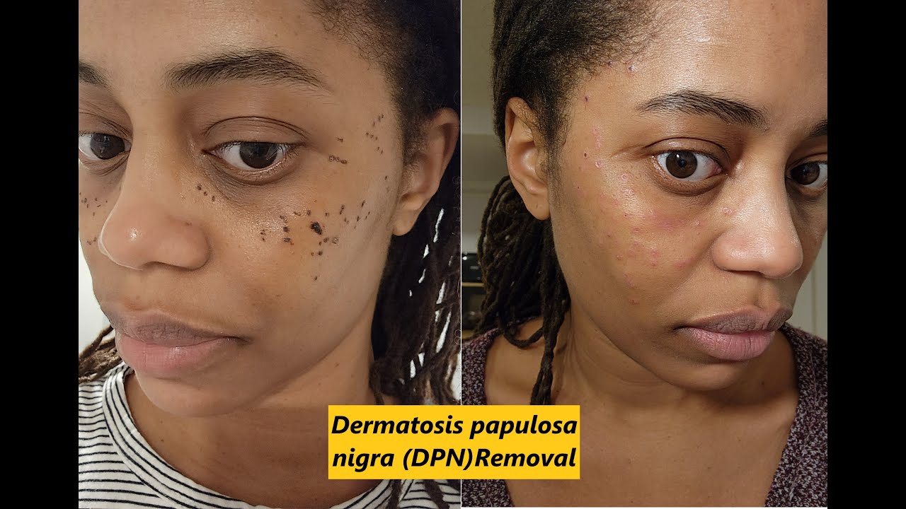 Dermatosis papulosa nigra (DPN) Removal