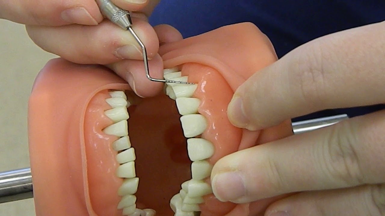 Periodontal Probe Technique